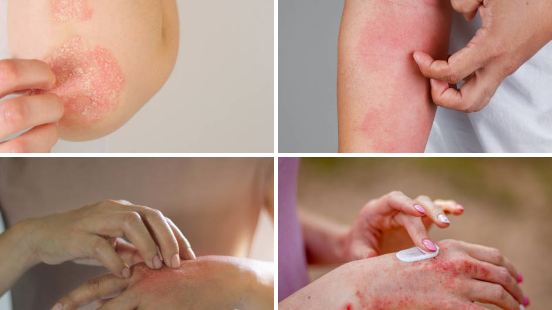 Why Fall and Winter Are the Seasons of Eczema Flares (And How to Manage Dry Skin in Cold Weather)