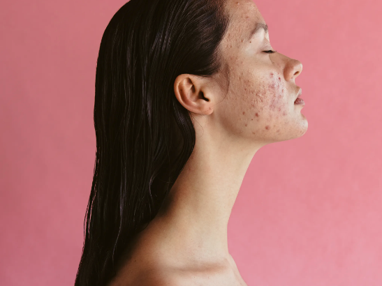 🌸 Understanding Excess Estrogen Levels 🌸