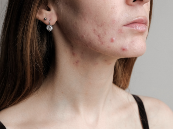 Managing Excess Estrogen in Women in Their 30s with DUTCH Lab Tests