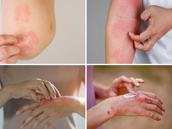 Why Fall and Winter Are the Seasons of Eczema Flares (And How to Manage Dry Skin in Cold Weather)