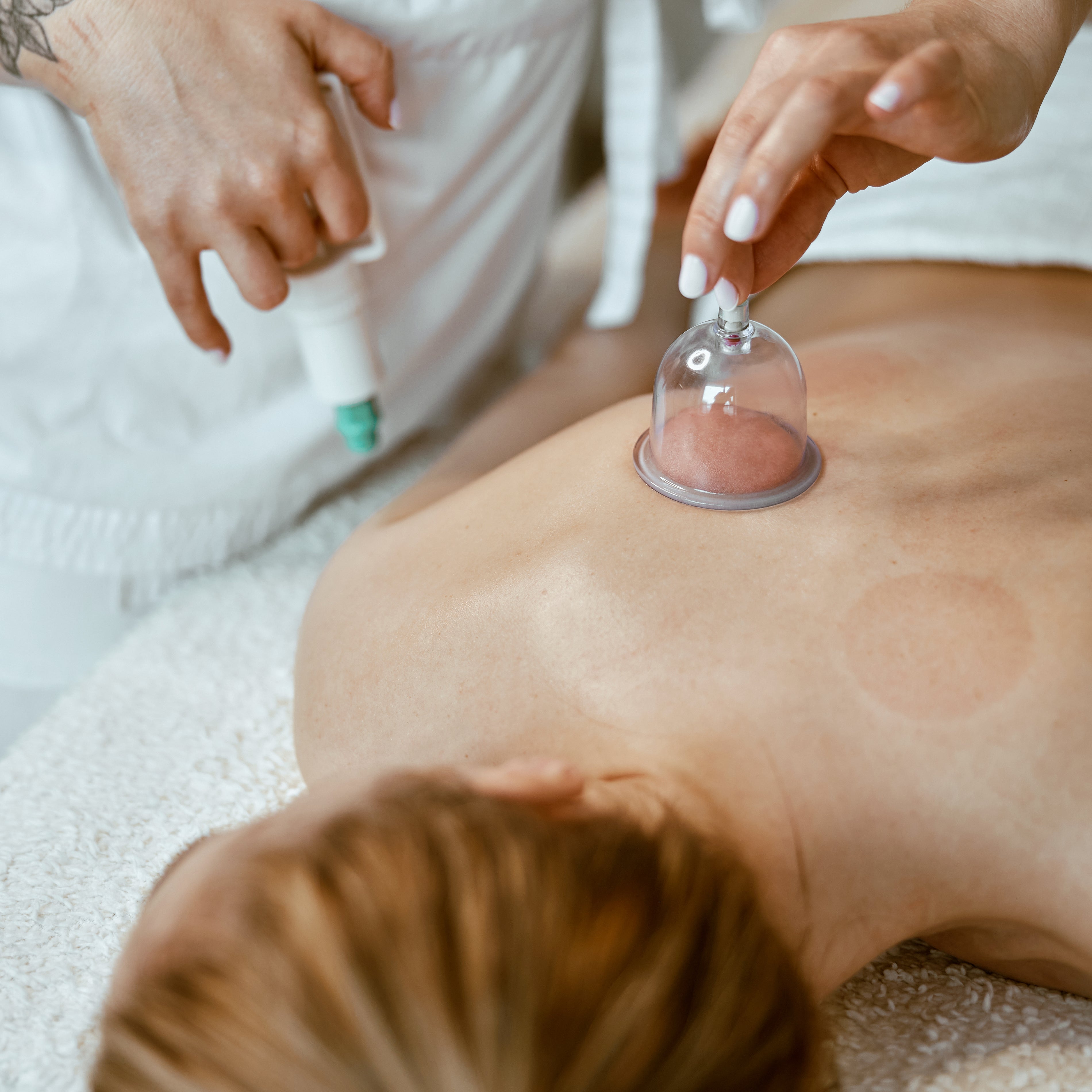 Cupping Therapy
